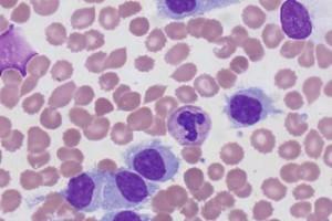 Leucémie à tricholeucocytes - symptômes et traitement de la maladie